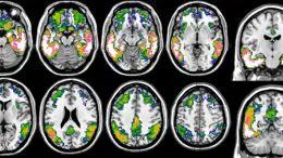 Tau Imaging With 18F Flortaucipir PET in Alzheimer’s Disease